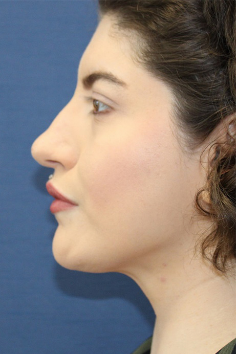 Female 29 years old face liposuction after