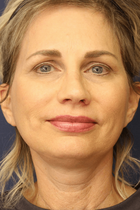 55-65 year old female facelift browlift blepharoplasty rhinoplasty after
