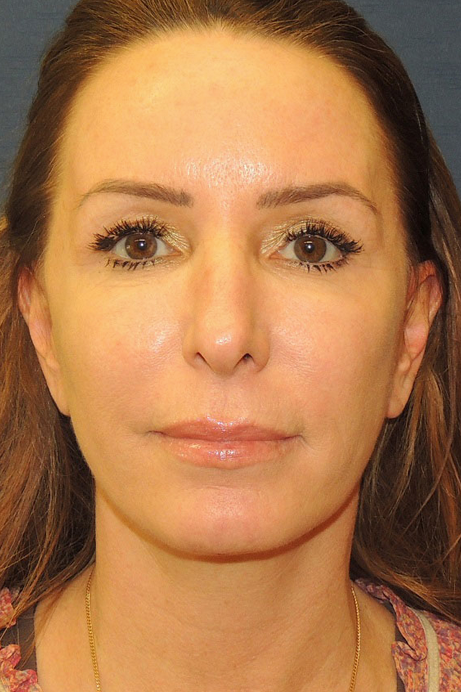 52 year old female mini facelift after