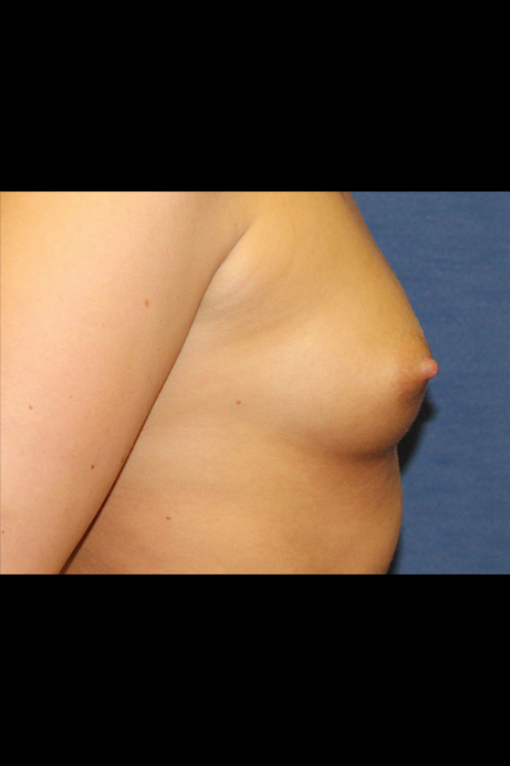 Female 25-30 Breast Augmentation Before