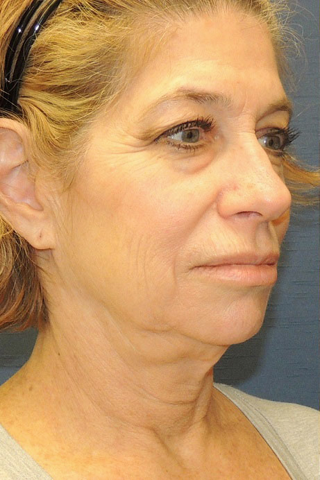 55-65 year old female facelift necklift blepharoplasty laser before