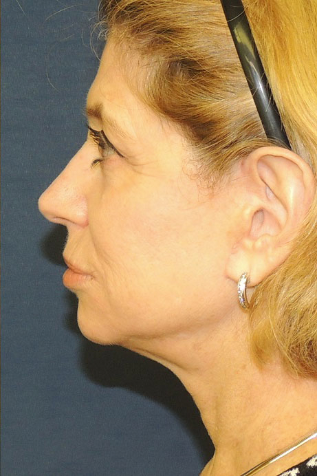 55-65 year old female facelift necklift blepharoplasty laser after