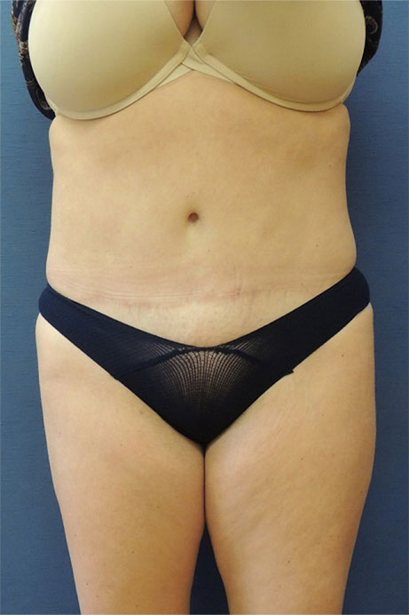 42 year old female abdominoplasty liposuction front after photo