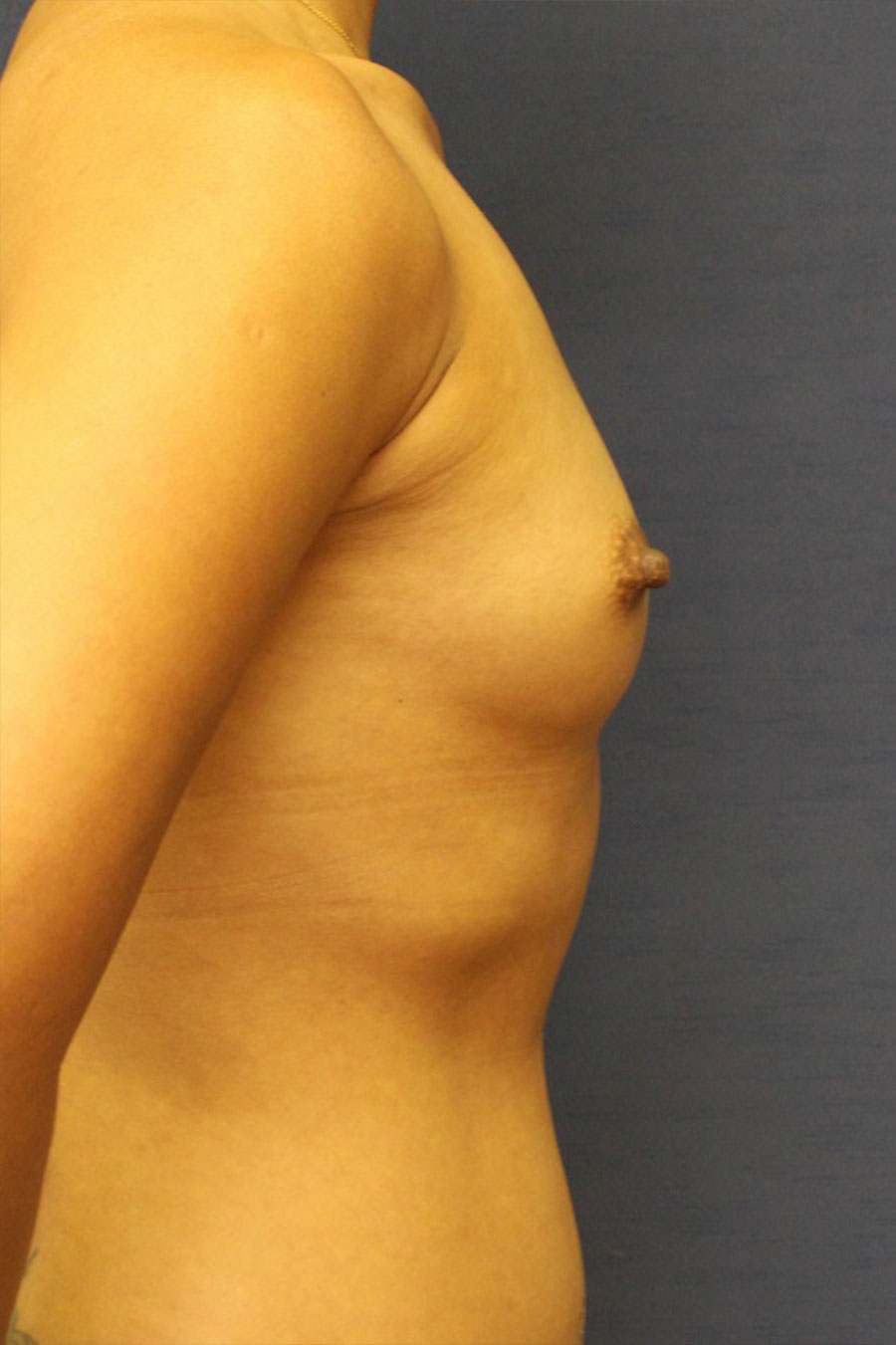  Breast Augmentation Female