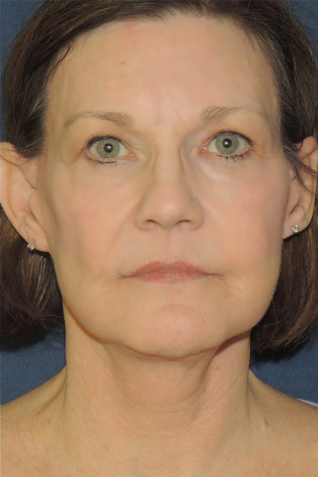 female brow lift after