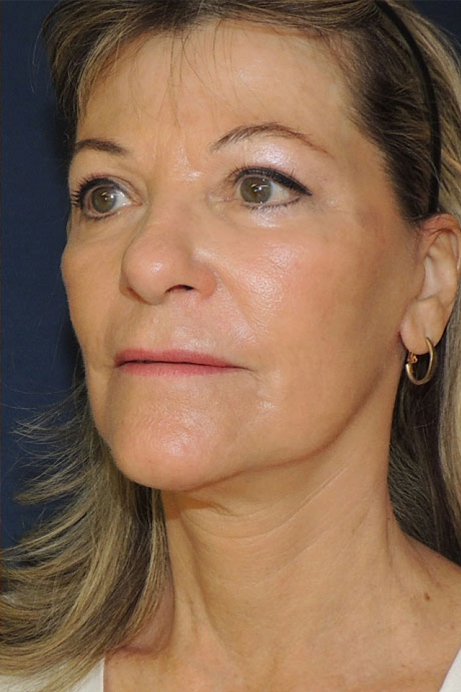female-60-70 -2-bleph-facelift-erbium-after-angle-2