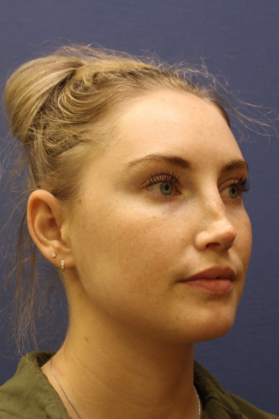 Rhinoplasty Revision Before