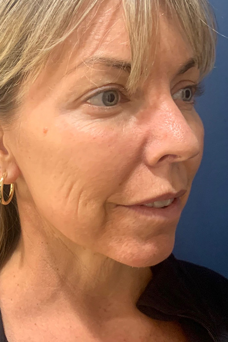 Dermal filler Sculptra after 3