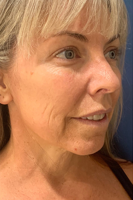 Dermal filler Sculptra before 3