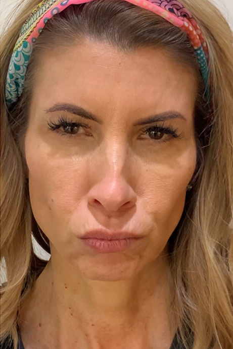 Botox after 2