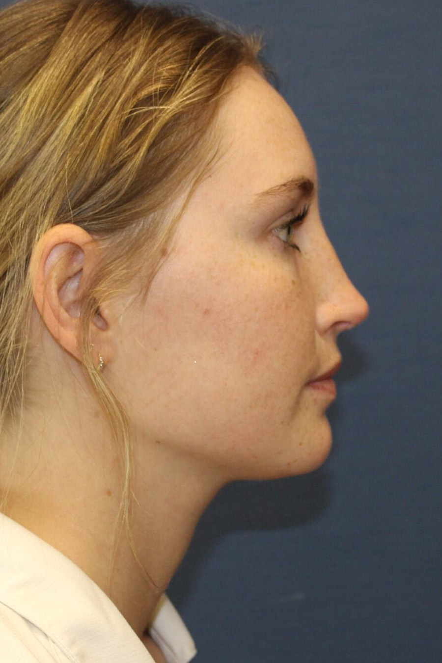 Rhinoplasty Revision After