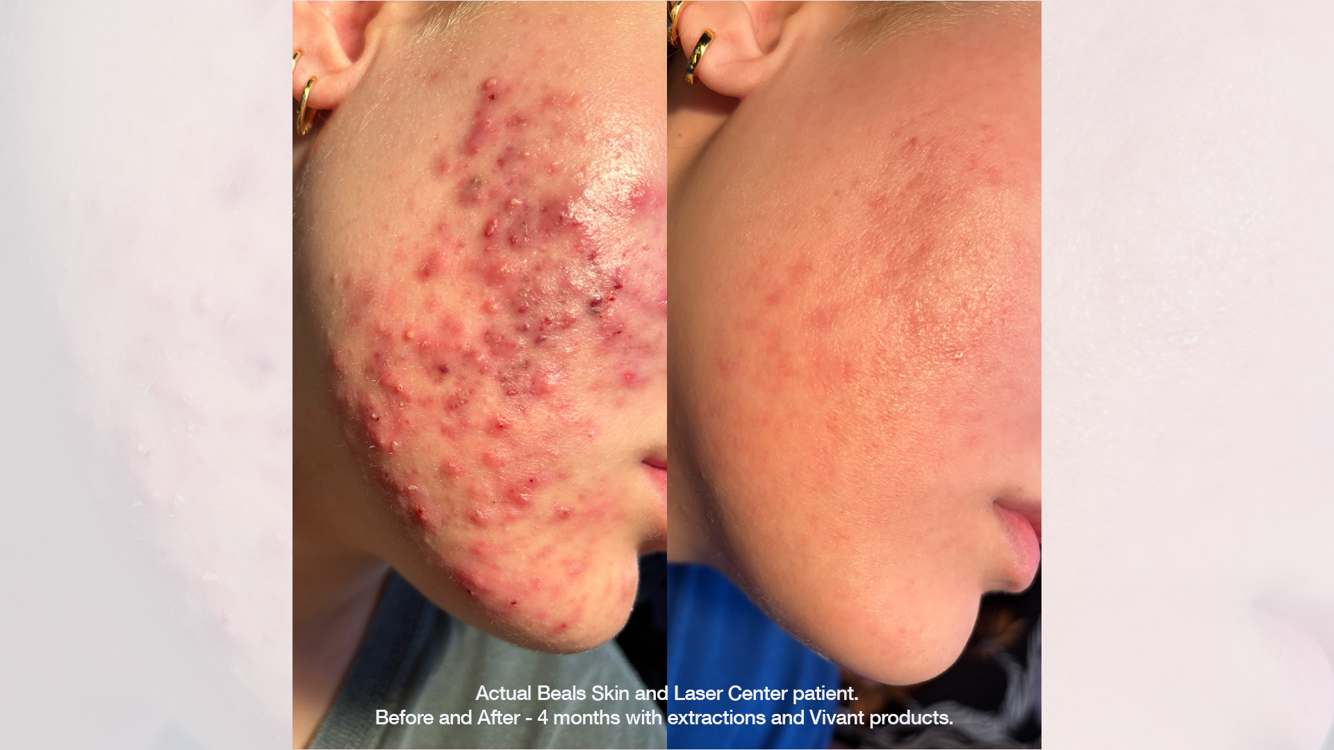 Aestheticians and Acne