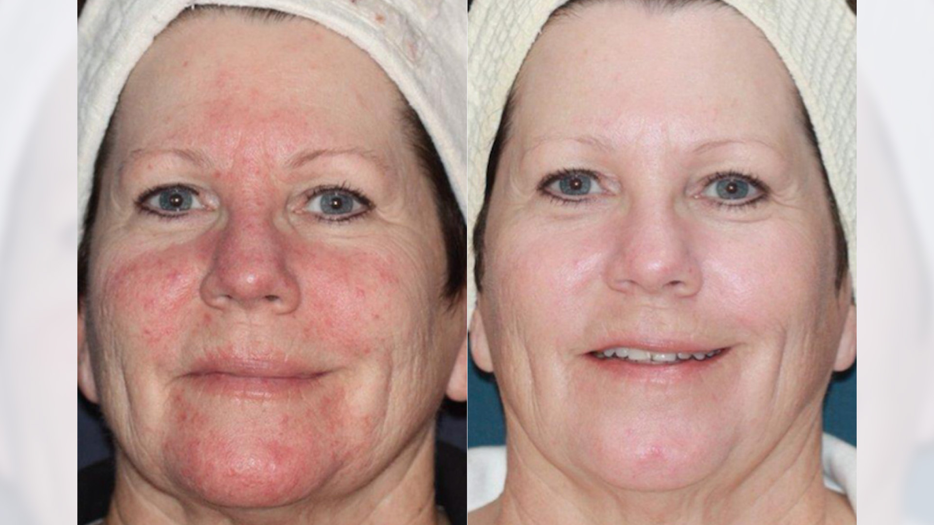 Rosé to Rosacea