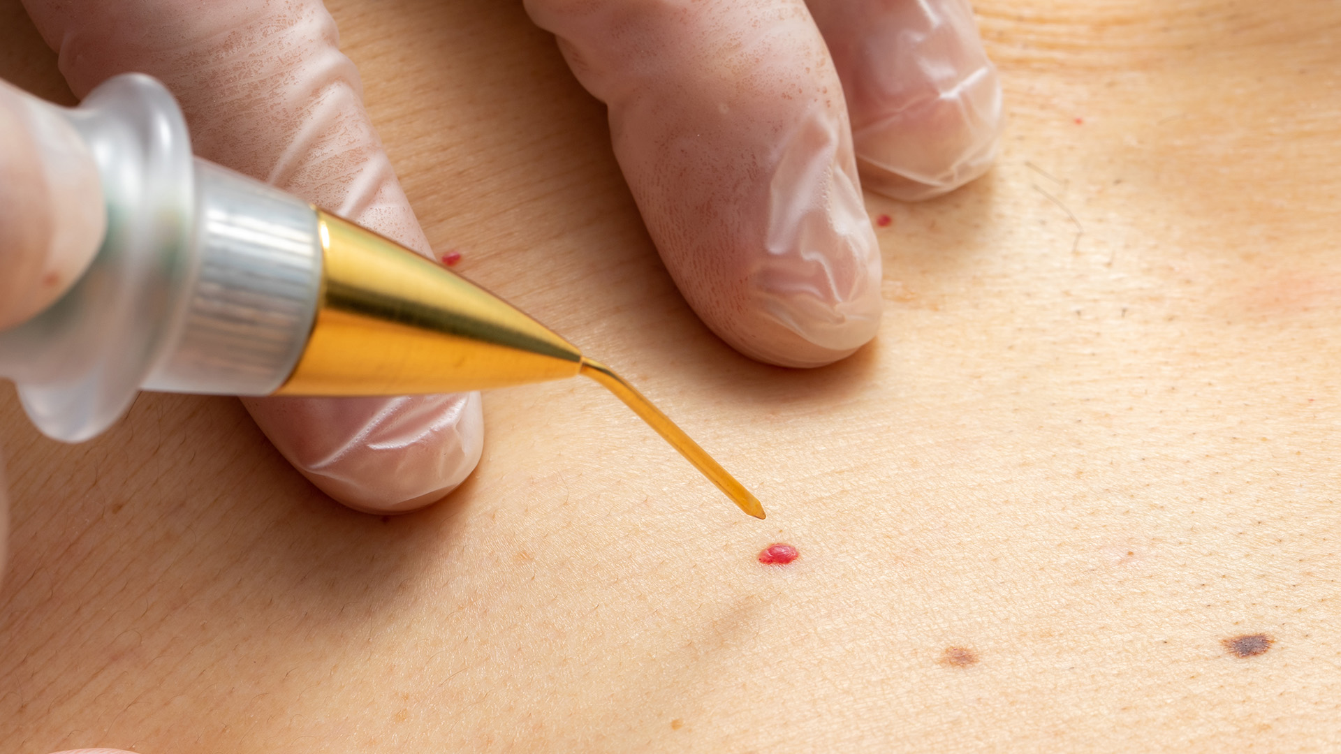 Cherry Angioma: Skin Lesion or Delicious Dessert?