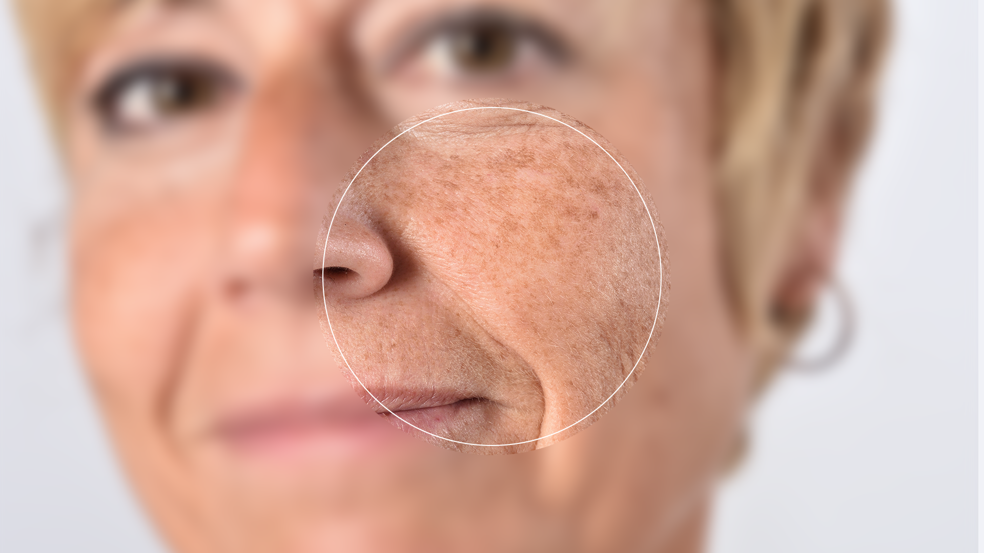 Beals Skin and Laser Age Spots Scottsdale Skin care