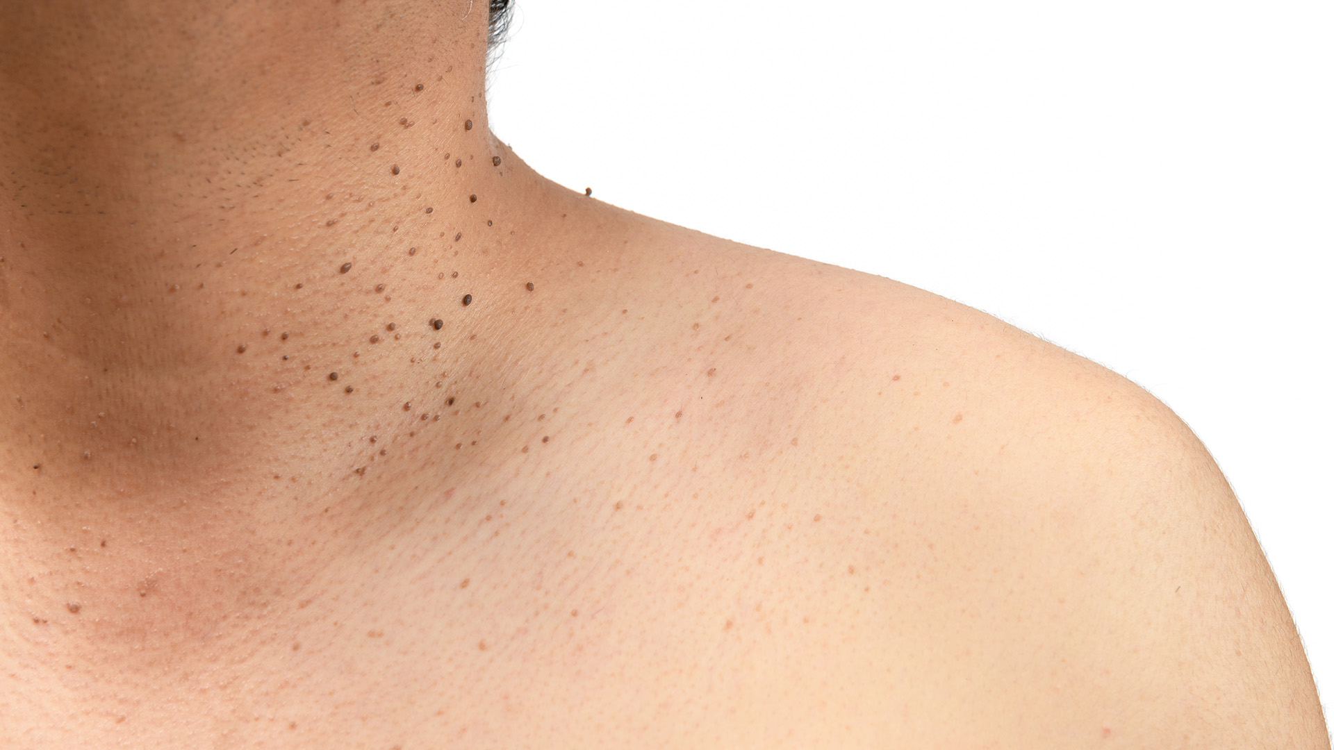 Seborrheic Keratosis