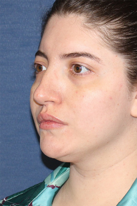 Female 29 years old face liposuction before