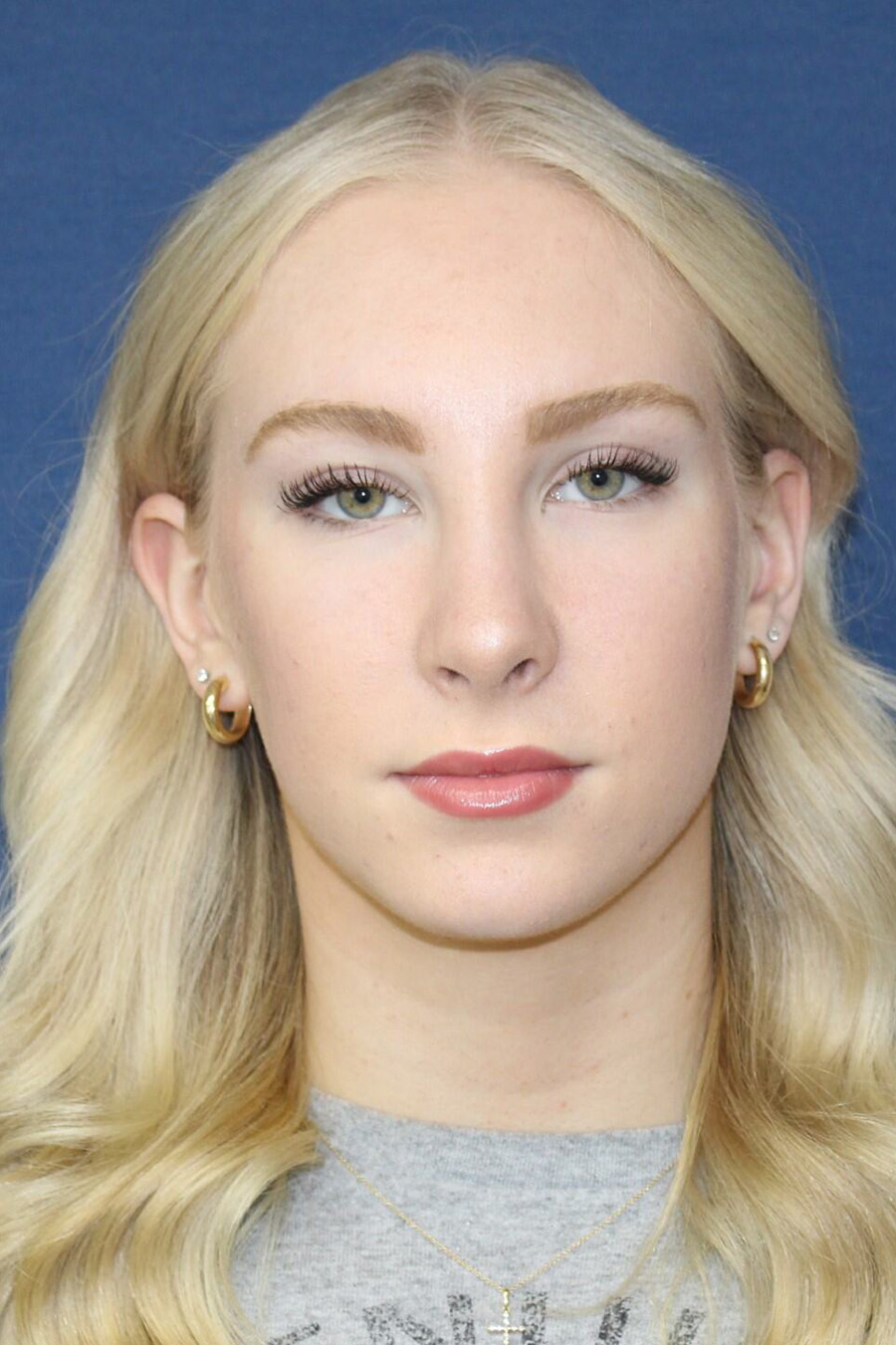 Patient Rhinoplasty RH2 - After