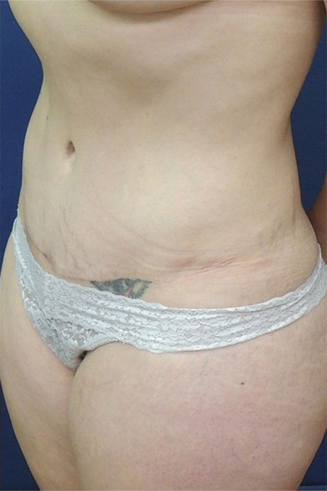 35 year old female abdominoplasty liposuction angle after photo