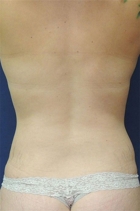 35 year old female abdominoplasty liposuction back after photo