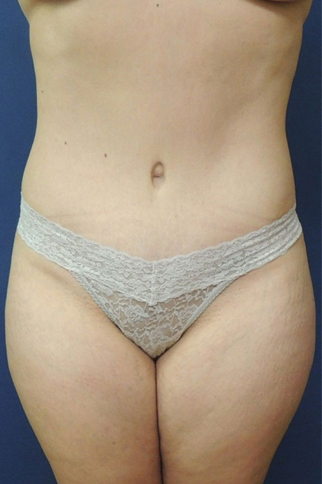 35 year old female abdominoplasty liposuction front after photo