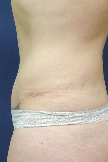 35 year old female abdominoplasty liposuction side after photo