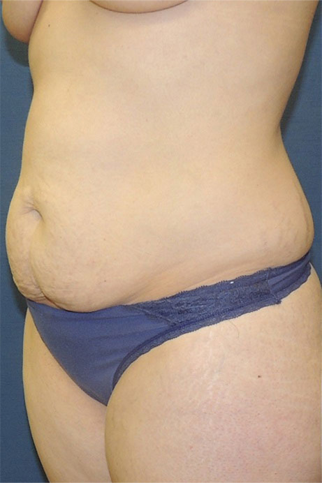35 year old female abdominoplasty liposuction angle before photo