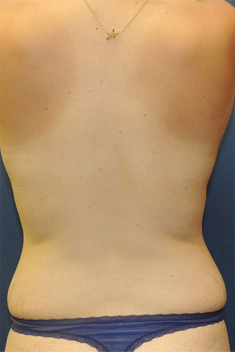 35 year old female abdominoplasty liposuction back before photo