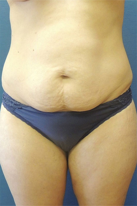 35 year old female abdominoplasty liposuction front before photo
