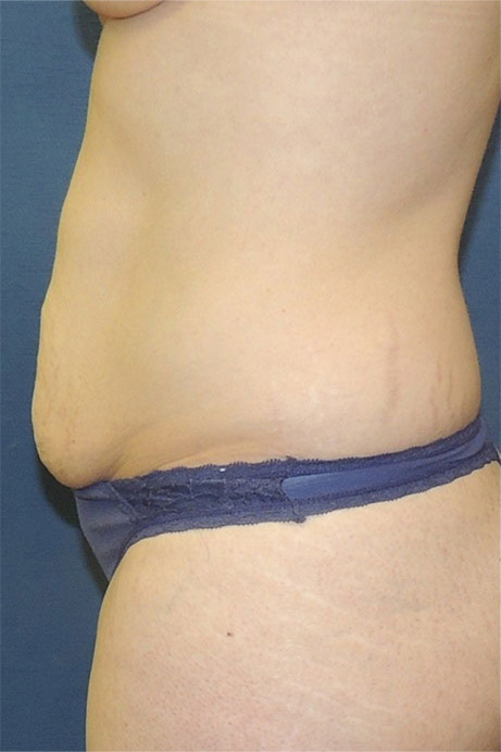 35 year old female abdominoplasty liposuction side before photo