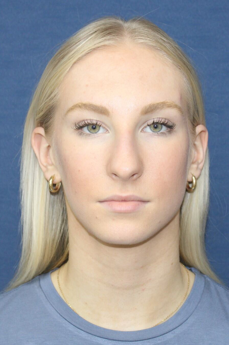 Patient Rhinoplasty RH2 - Before