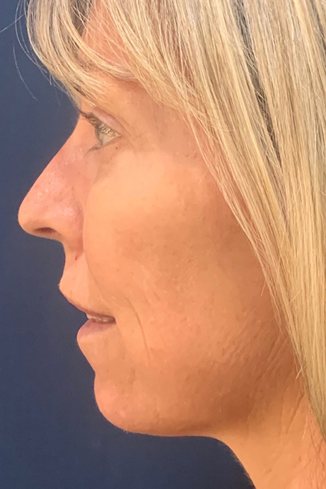 Dermal filler Sculptra after 2