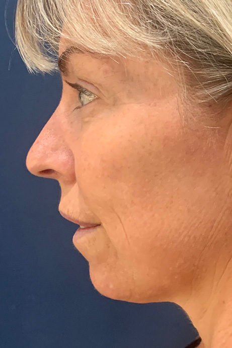 Dermal filler Sculptra before 2