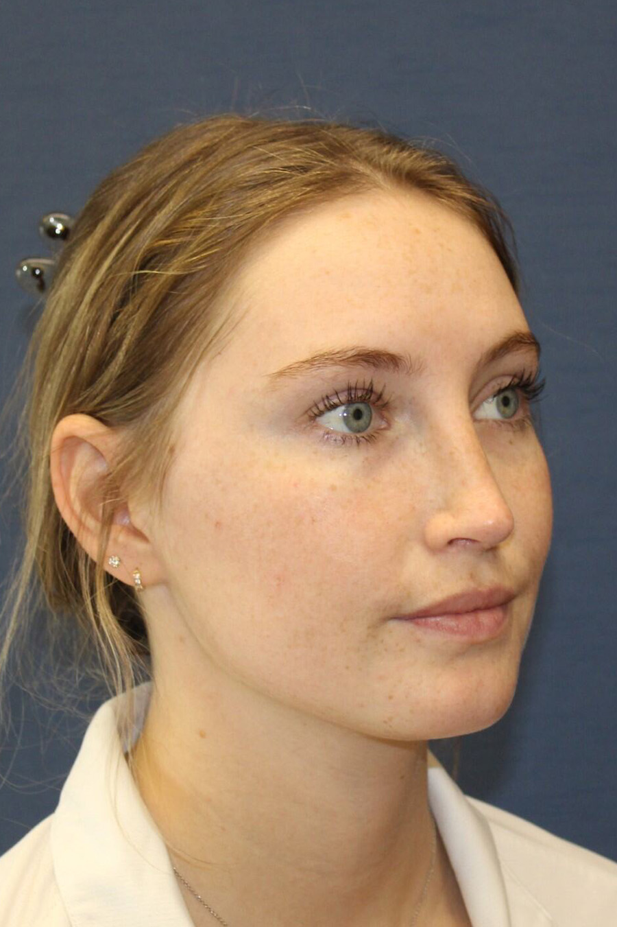 Rhinoplasty Revision After