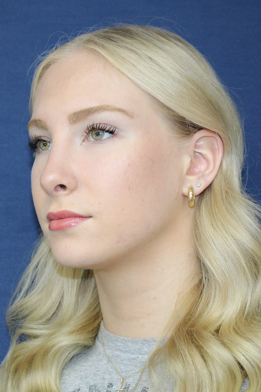 Patient Rhinoplasty RH2 - After