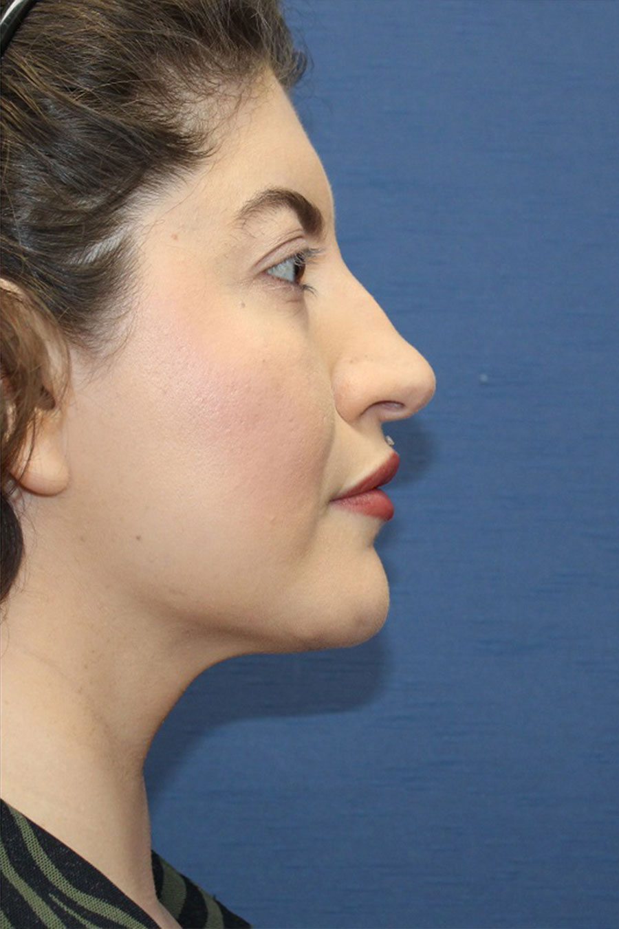 Patient 29-Liposuction to Neck