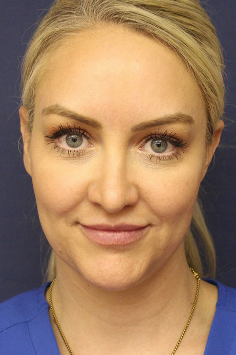 Female 37 years old face liposuction before
