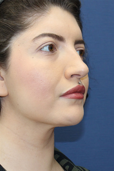 Female 29 years old face liposuction after