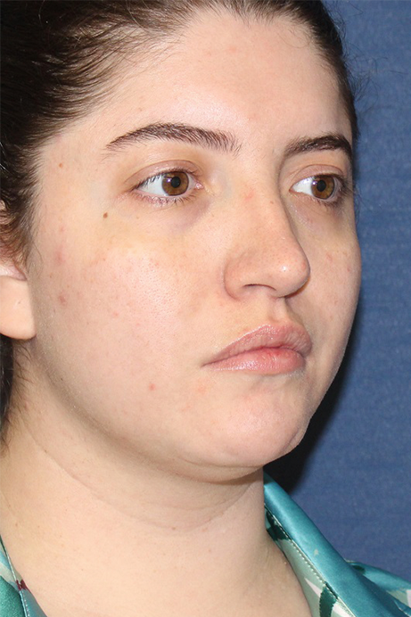 Female 29 years old face liposuction before