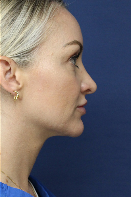 Female 30-40 years old face liposuction after