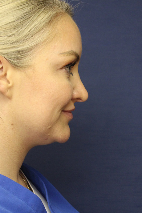 Female 30-40 years old face liposuction before