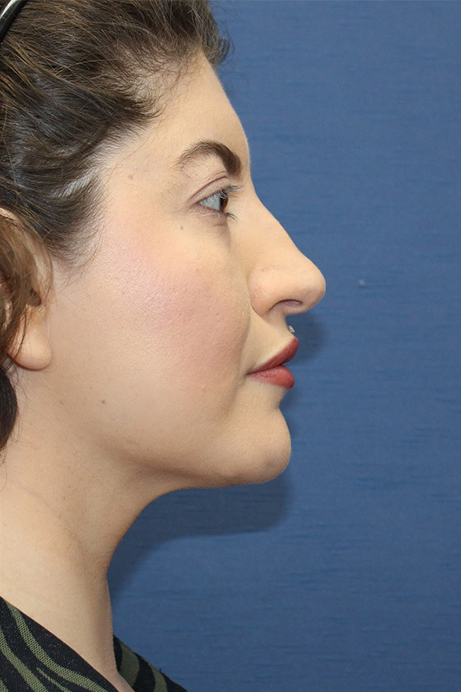 Female 29 years old face liposuction after