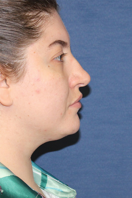 Female 29 years old face liposuction before