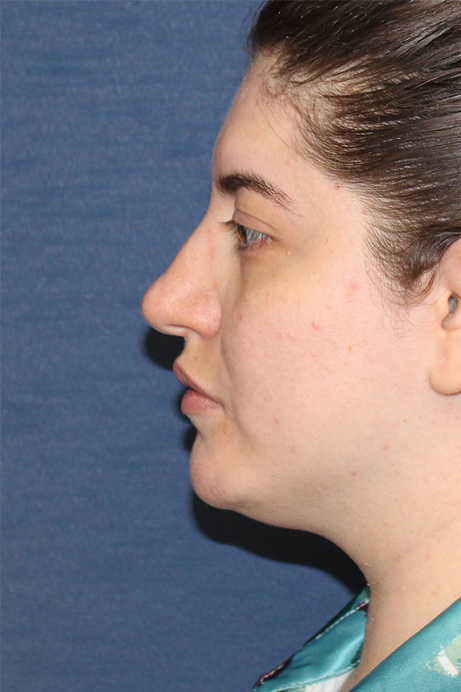 Female 29 years old face liposuction before