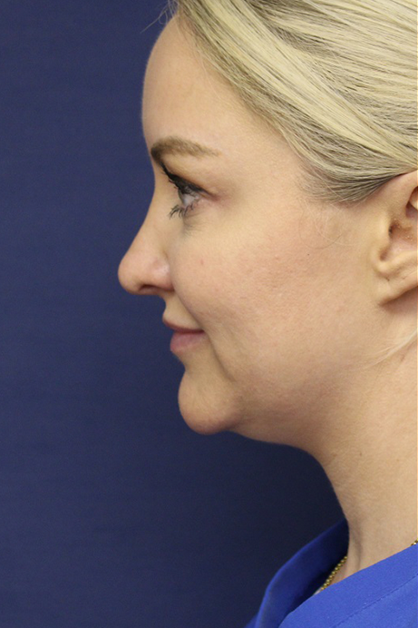 Female 30-40 years old face liposuction before