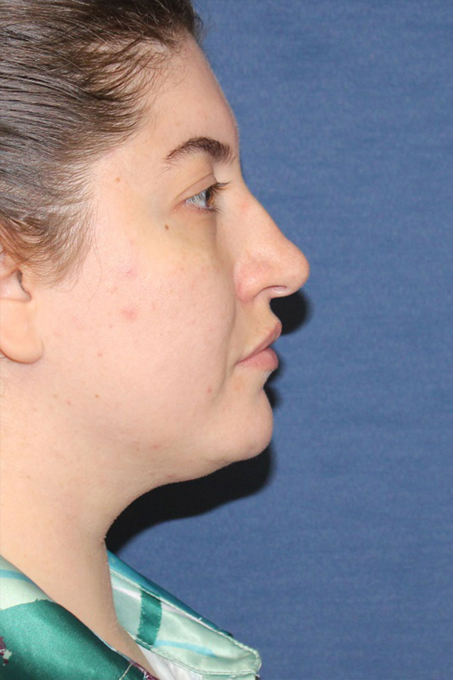 Patient 29-Liposuction to Neck