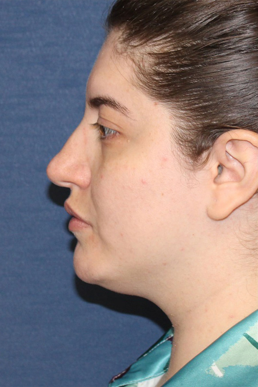Patient 29-Liposuction to Neck