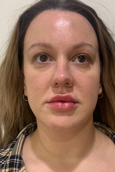 Dermal filler lips after 2