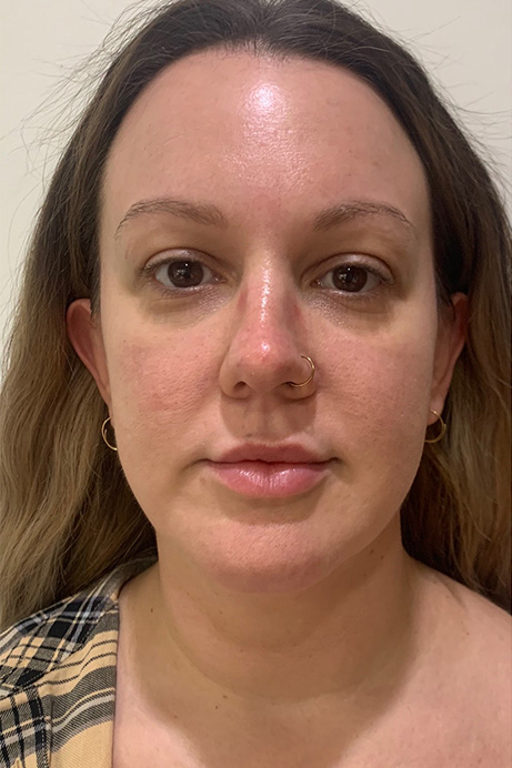 Dermal filler lips before 2