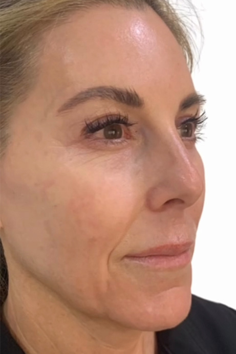 Dermal filler facial balancing before 2